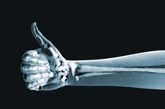 Röntgen zur Diagnose von Schmerzen in den Fingergelenken