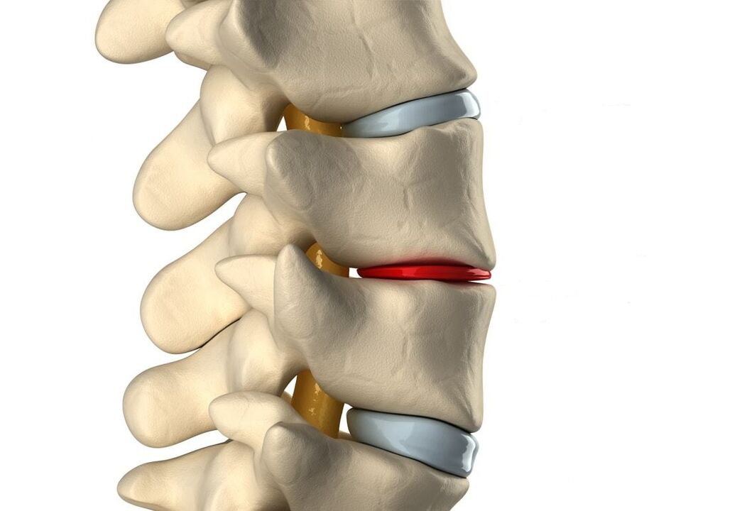 Gesunde Bandscheibe (blau) und geschädigt durch thorakale Osteochondrose (rot)