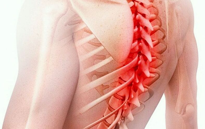 Osteochondrose der Brustwirbelsäule