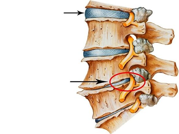 Störungen an Zwischenvertebralscheiben