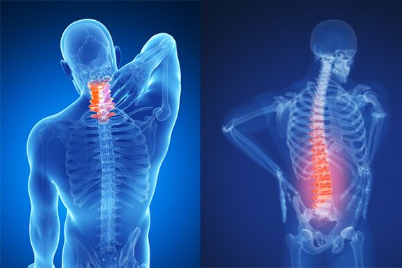 Osteochondrose der Hals- und Lendenwirbelsäule