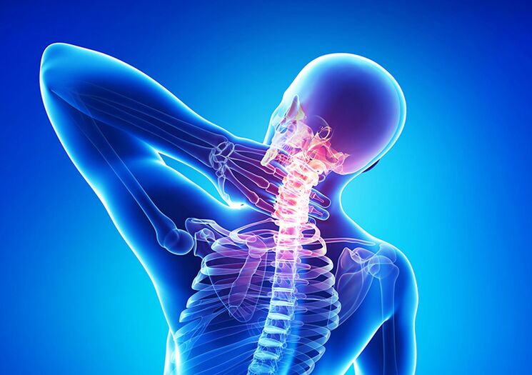 Wirbelsäulenosteochondrose ist eine Krankheit, die Gelenkknorpel und Wirbel betrifft.