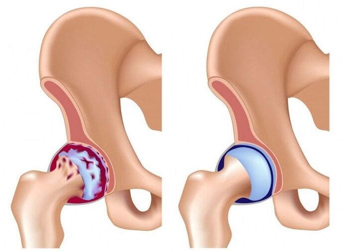 Schädigung des Hüftgelenks durch Arthrose