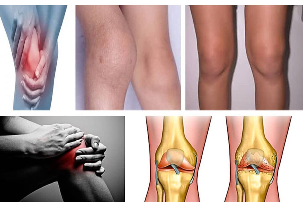 Arthrose, was ist das