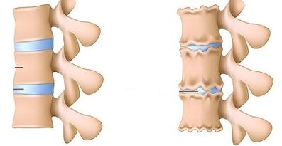wie man das Vorhandensein von Osteochondrose der Lendenwirbelsäule erkennt