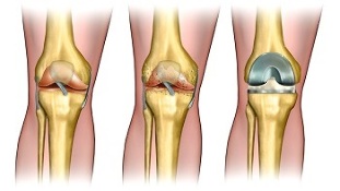 Endoprothetik bei Arthrose des Kniegelenks